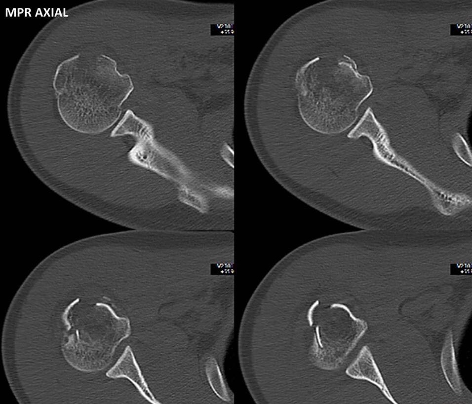 Caso clÃ­nico de Fractura de hombro por tomografÃ­a imagen 3d vrt
