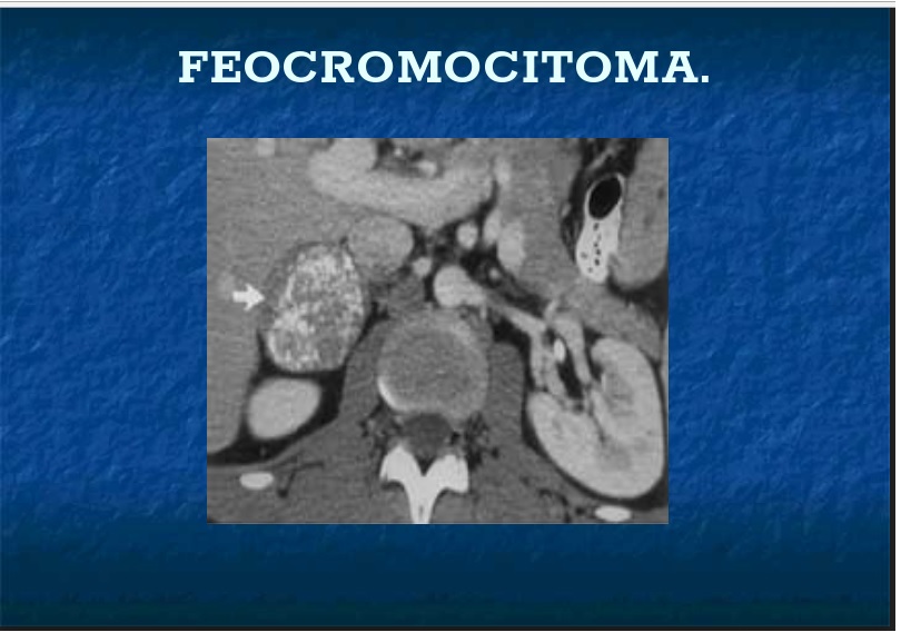 TUMORES HIPERFUNCIONANTES DE LA MEDULA SUPRARRENAL (FEOCROMOCITOMA)