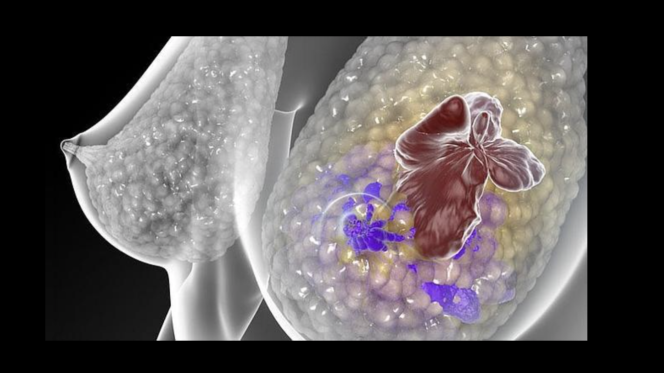 Cancer de mamÃ¡ en pacientes TRANS