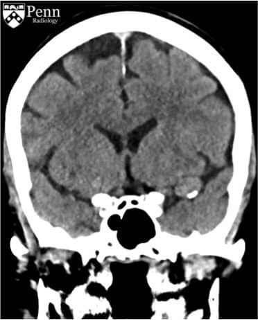 Caso clÃ­nico aneurisma de la arteria cerebral media segmento M2