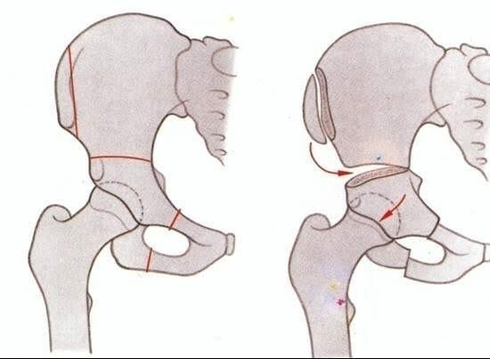 Se hace una osteotomia de femur prox para bajar la cadera y una triple osteotomia de steel por q es un adulto