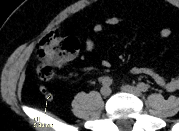apendicitis por tomografÃ­a