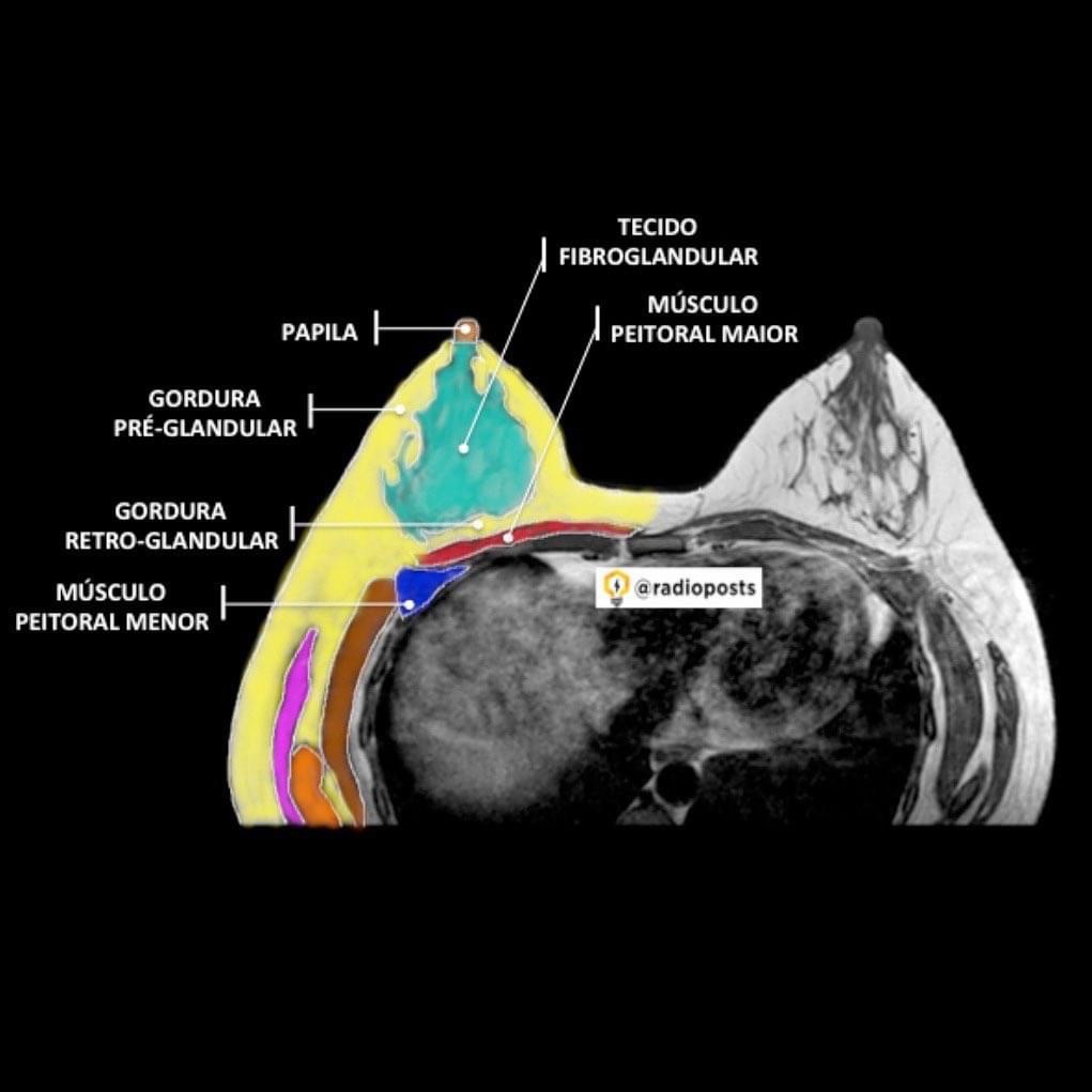 Anatomía de mama en RM
