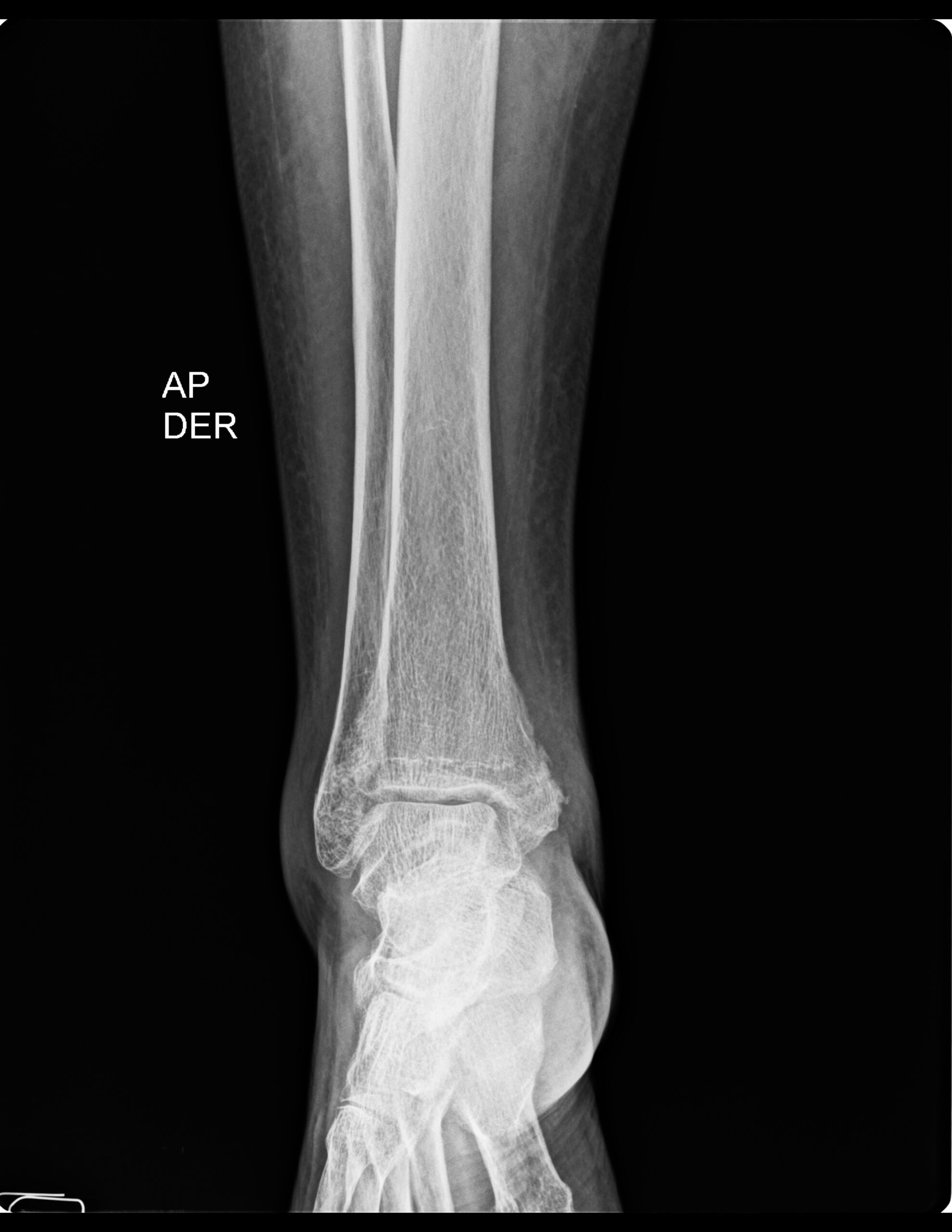 FRACTURA OBLICUA EN MALÉOLO LATERAL