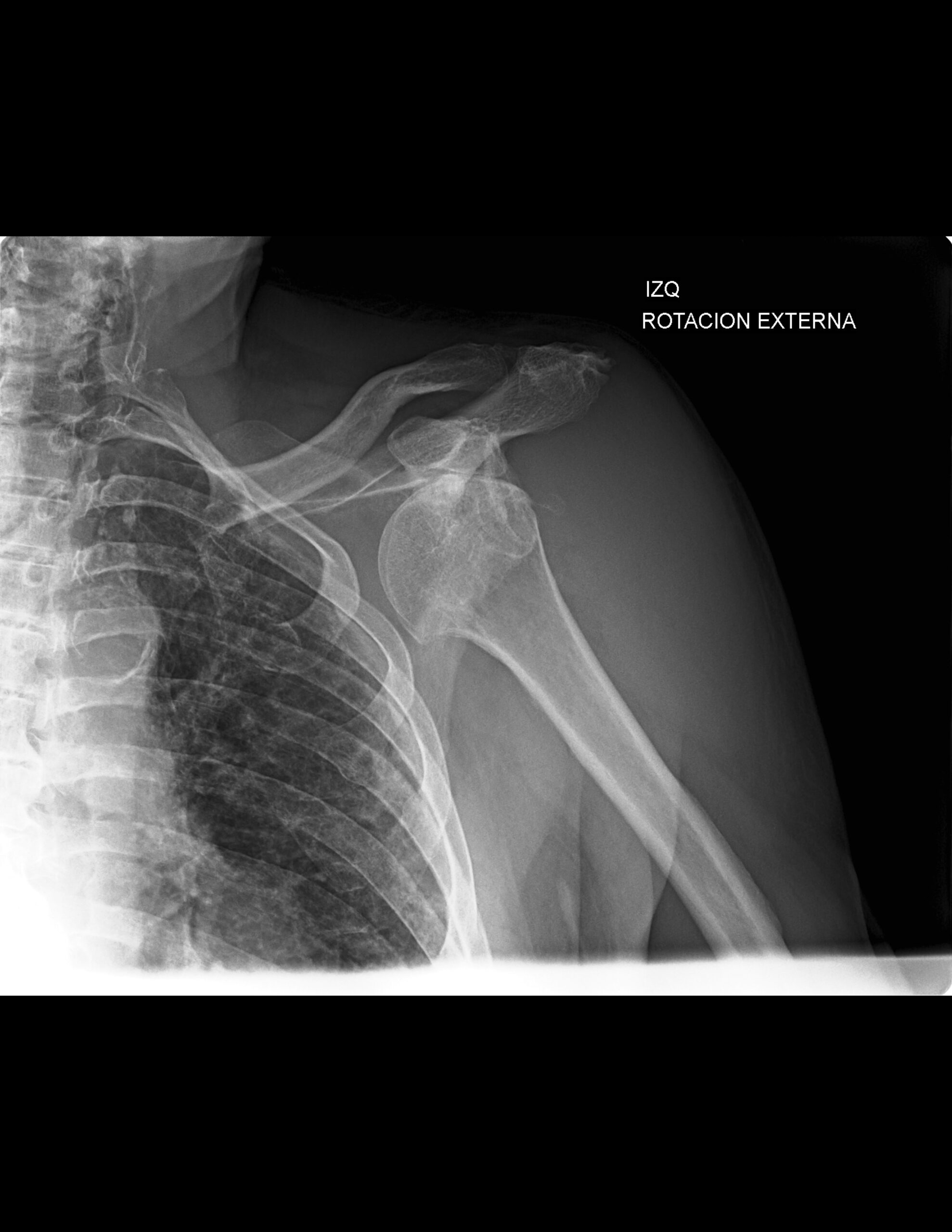 DISLOCACIÓN DE HOMBRO ANTERIOR