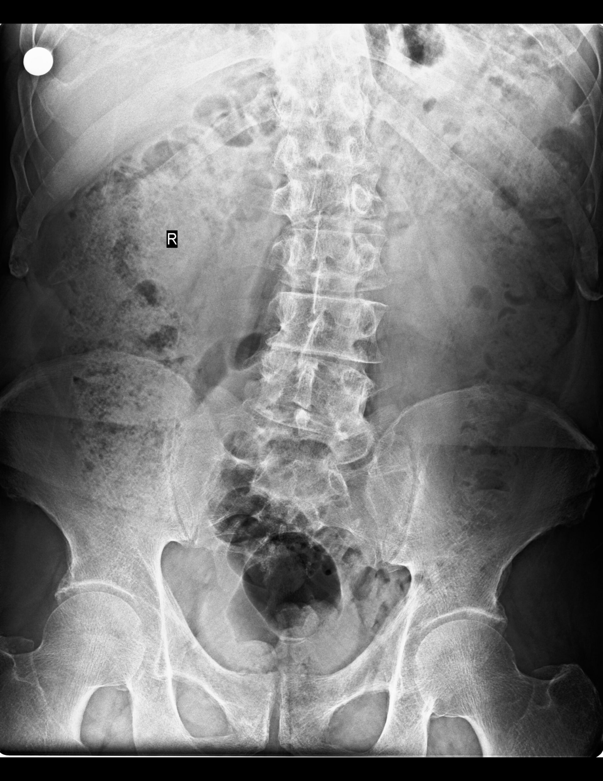 ANQUILOSIS DE L5 CON S1 Y L5 CON SACRALIZACIÓN (CASTELLVI III-B)