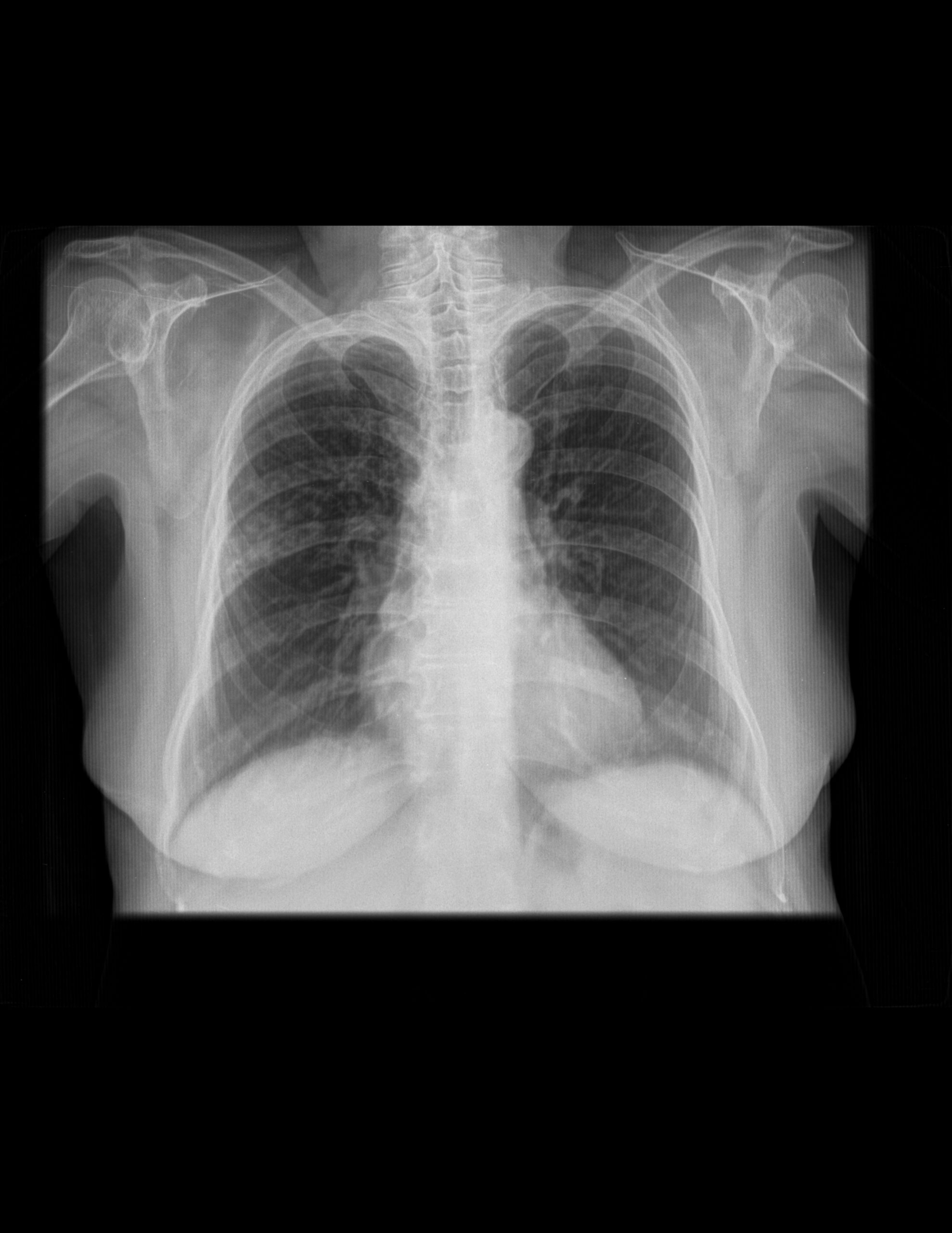 PARÉNQUIMA PULMONAR DERECHO, EN LÓBULO SUPERIOR CON DATOS DE NEUMOPATÍA CRÓNICA INTERSTICIAL.