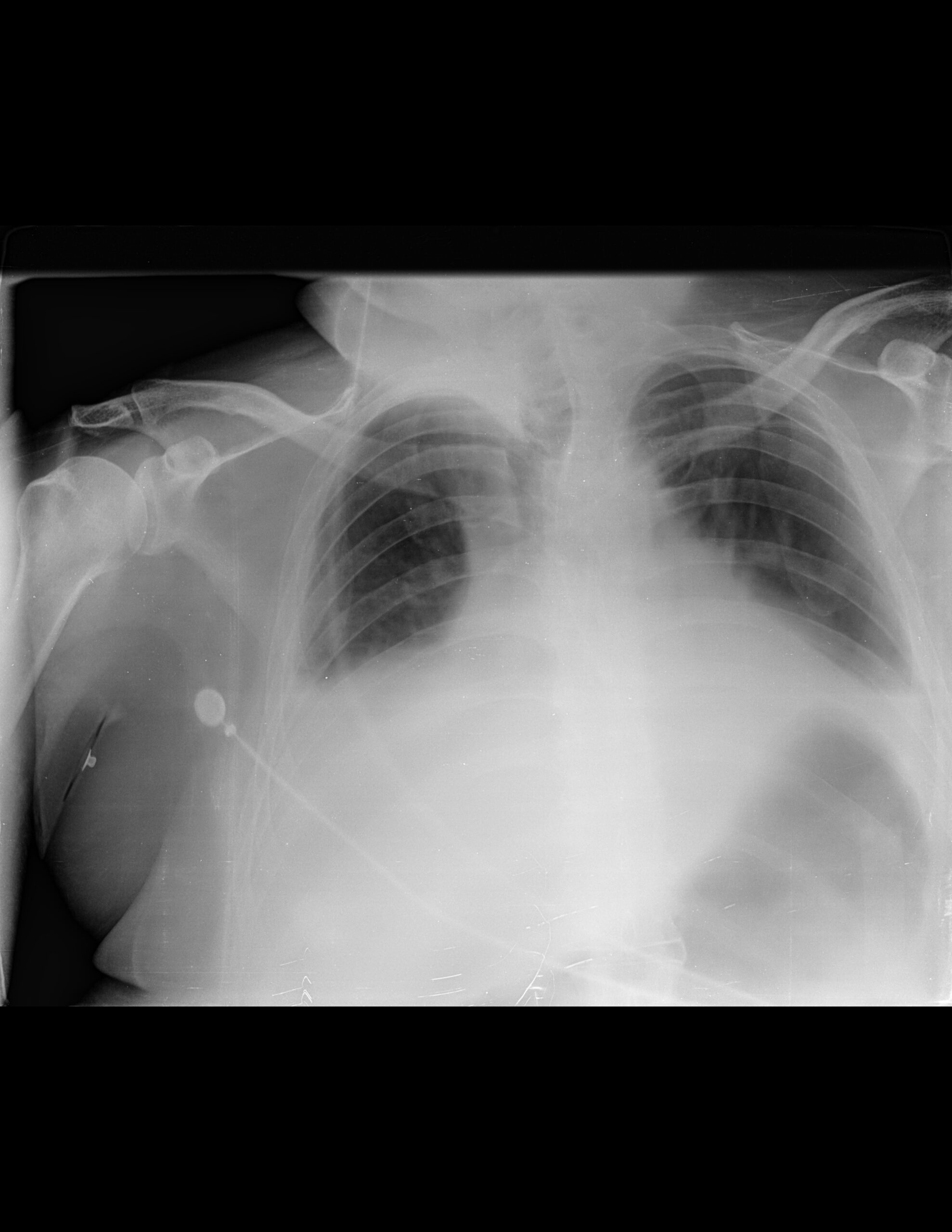 EXISTE DERRAME PLEURAL BILATERAL DE PREDOMINIO DERECHO Y REDISTRIBUCIÓN VASCULAR CEFÁLICA