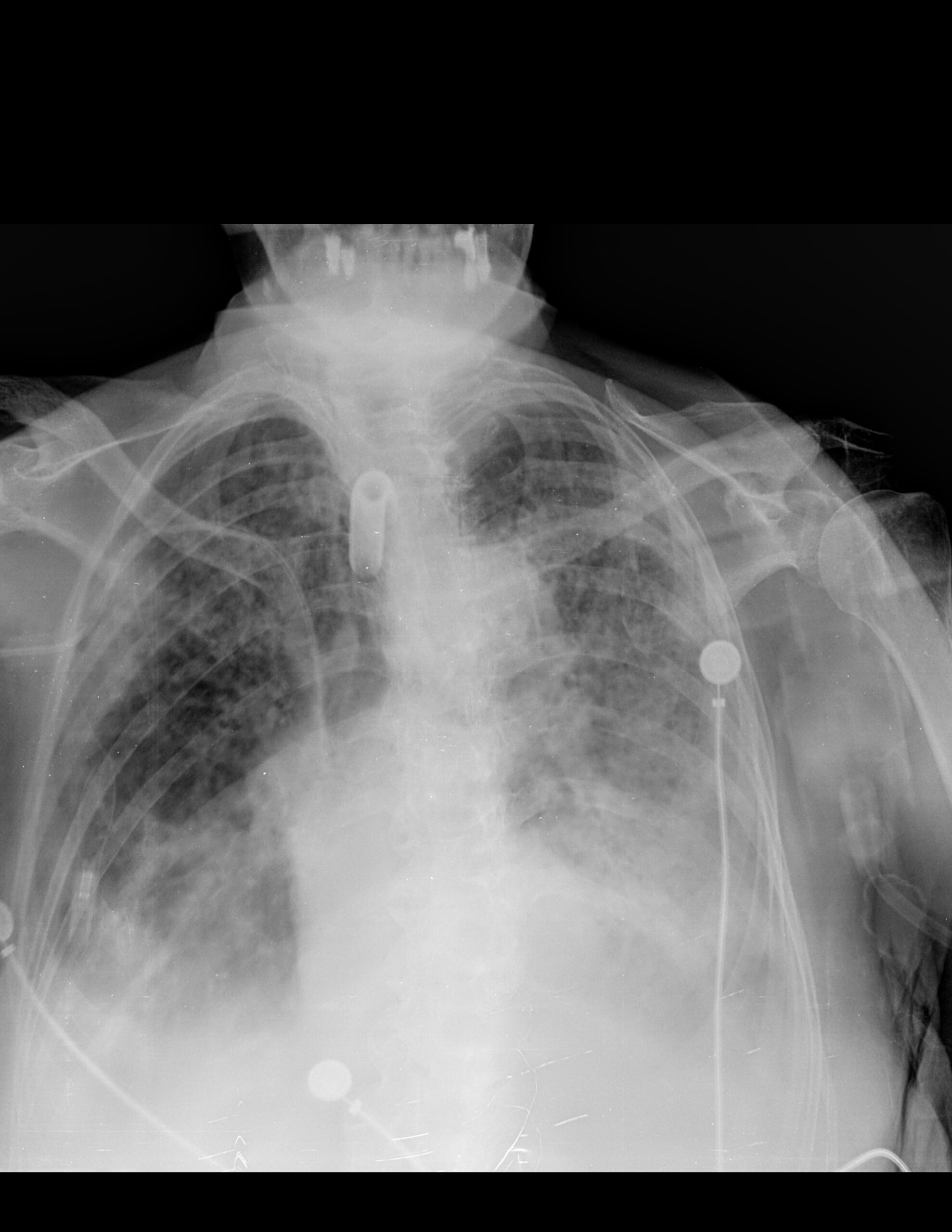 DATOS DE NEUMOPATÍA CRÓNICA INTERSTICIAL CON PROCESO NEUMÓNICO BASAL BILATERAL Y DERRAME PLEURAL BILATERAL, DE PREDOMINIO IZQUIERDO