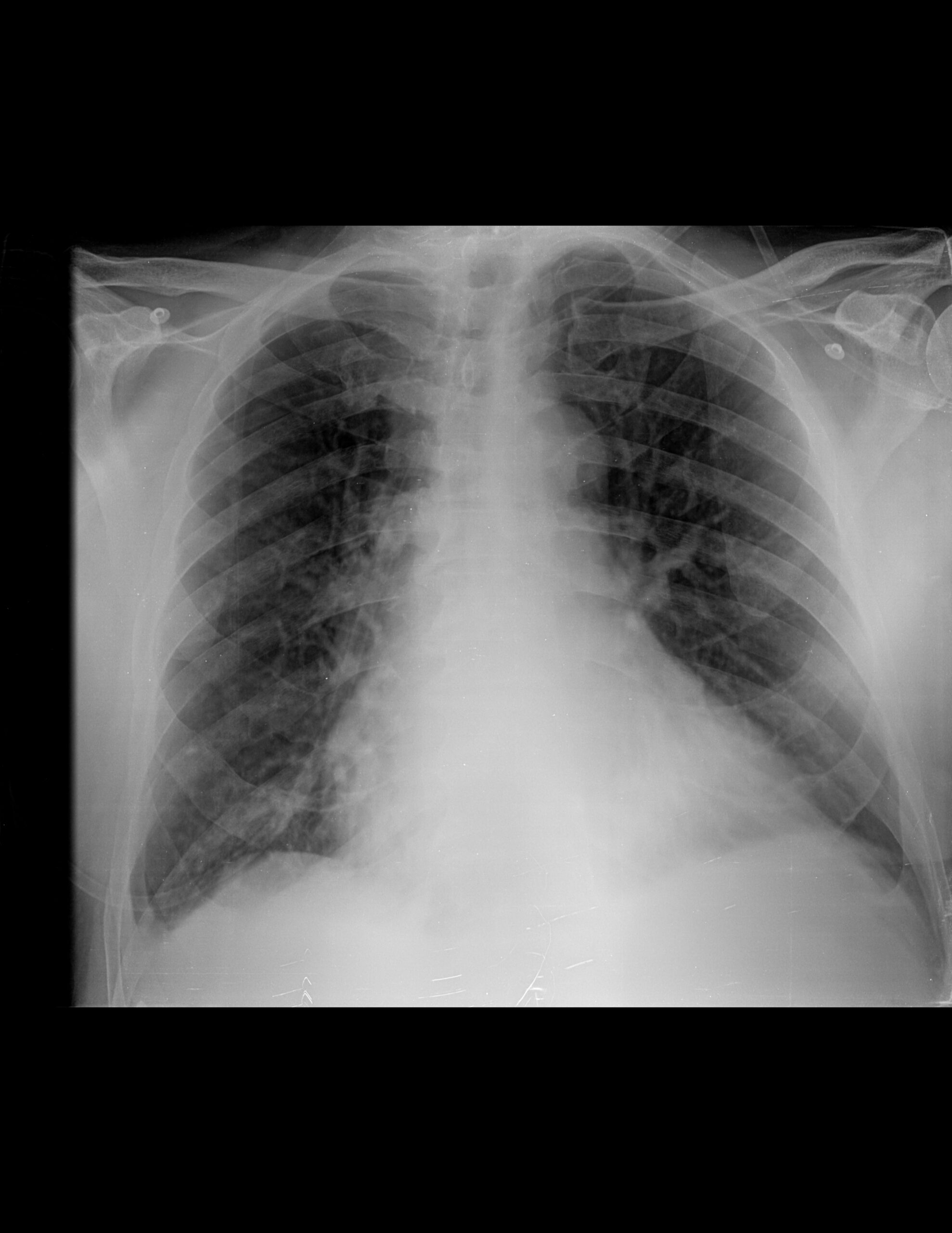 NEUMOPATÍA CRÓNICA INTERSTICIAL Y REDISTRIBUCIÓN VASCULAR PROBABLEMENTE DE ORIGEN CARDIOGÉNICO