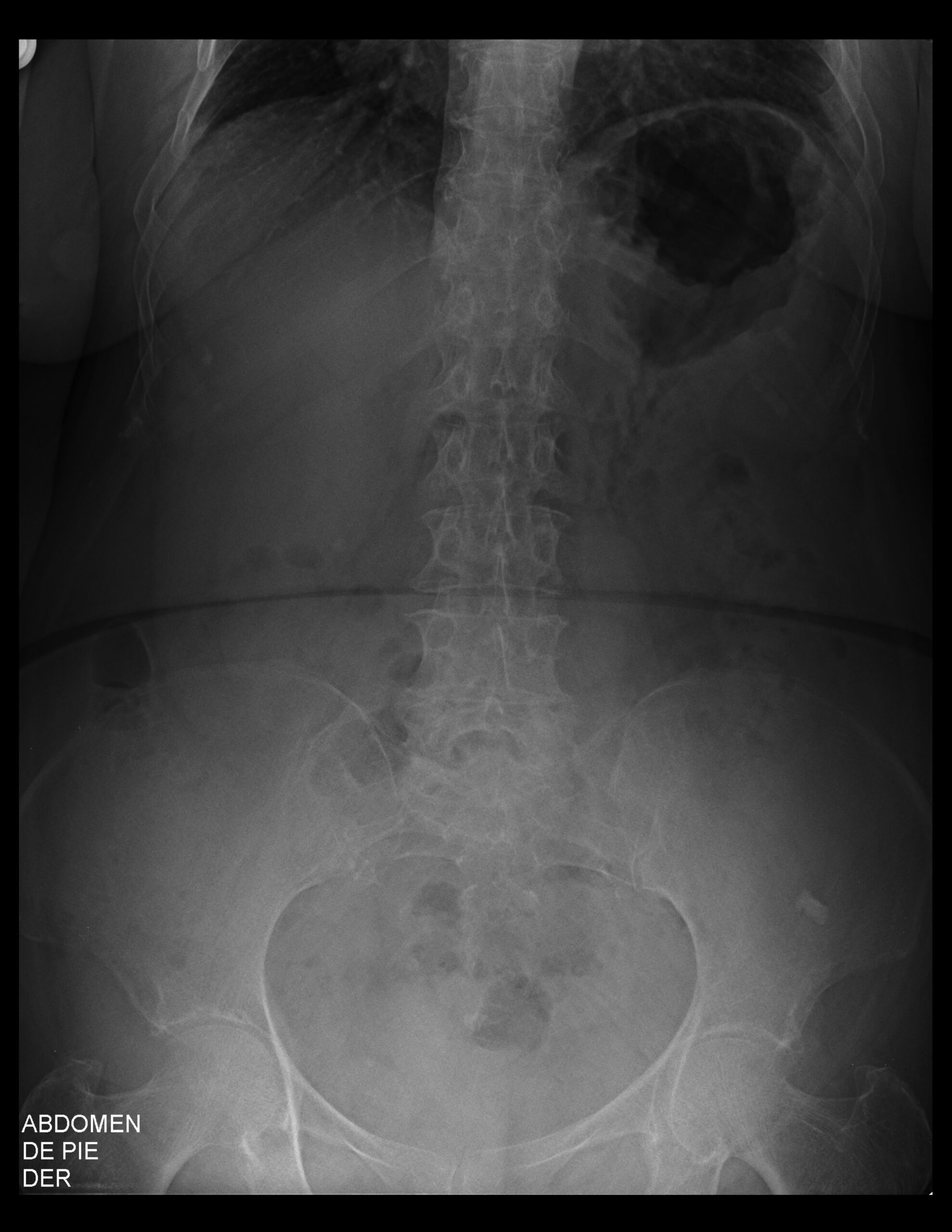 CALCIFICACIÓN EN TOPOGRAFÍA RENAL DERECHA QUE PODRÍA CORRESPONDER A UN LITO.