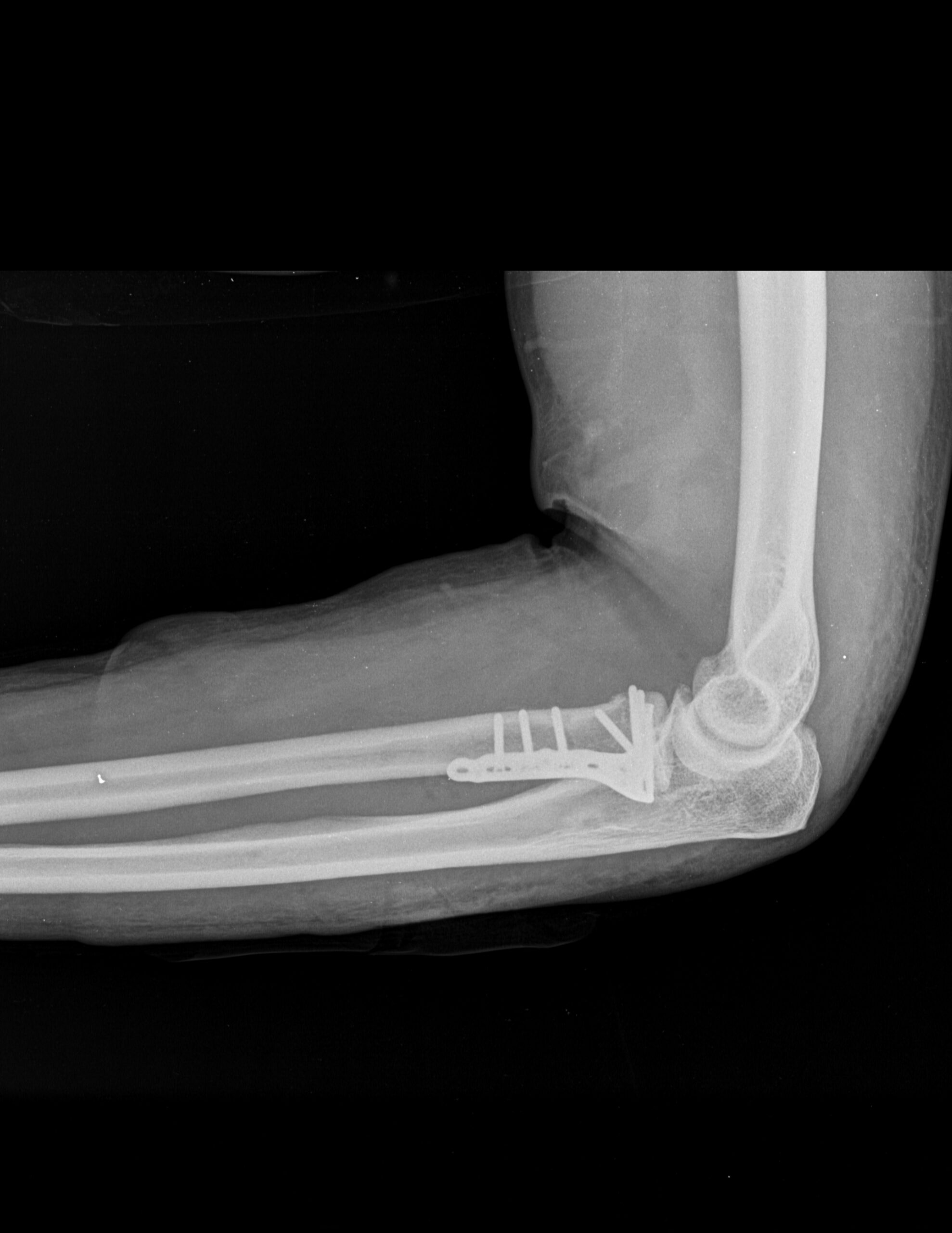 A NIVEL DE RADIO DISTAL CON MATERIAL DE OSTEOSÍNTESIS CON ADECUADA COLOCACIÓN Y EDEMA PERIFÉRICO ASOCIADO