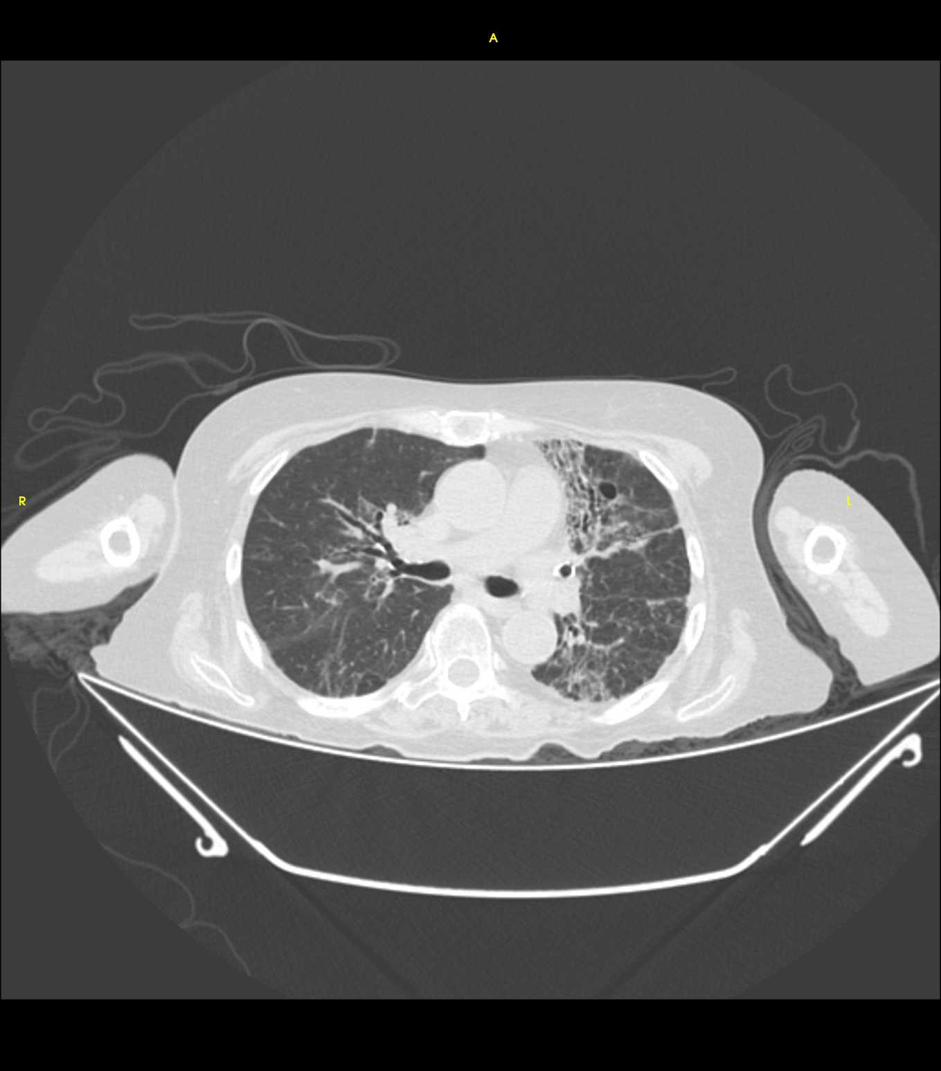 NEUMOPATÍA CRÓNICA INTERSTICIAL CON BRONQUIECTASIAS Y PROCESÓ NEUMÓNICO DE FOCOS MÚLTIPLES