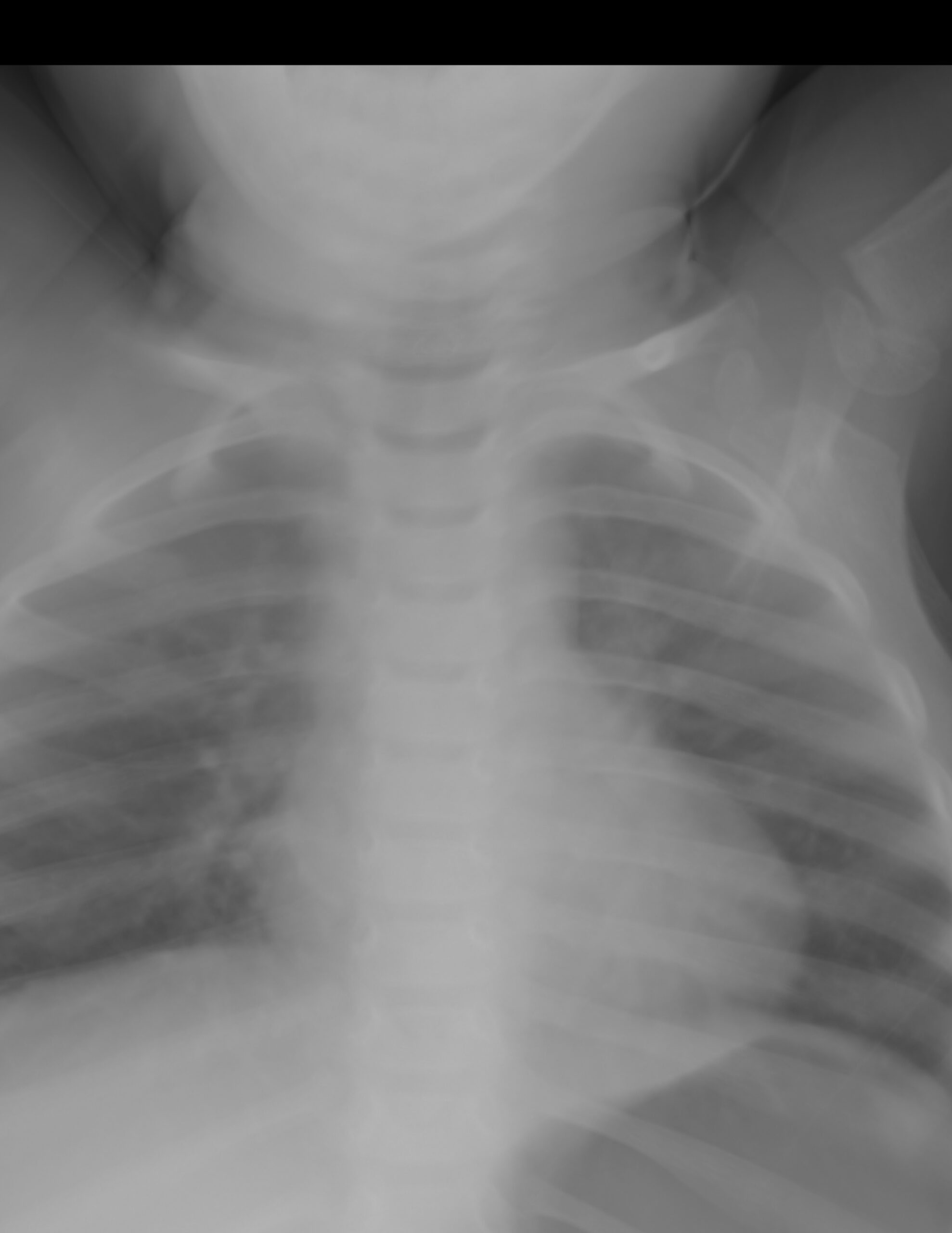 PROCESO NEUMÓNICO A NIVEL APICAL IZQUIERDO, ASÍ CÓMO DATOS DE BRONQUIOLITIS BILATERAL