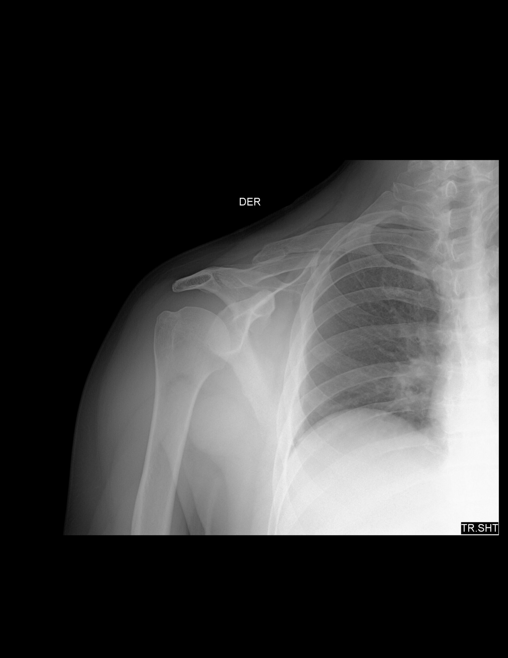 FRACTURA DE CARACTERÍSTICAS ANTIGUAS DE TERCIO DISTAL DE CLAVÍCULA, CON DESPLAZAMIENTO CAUDAL