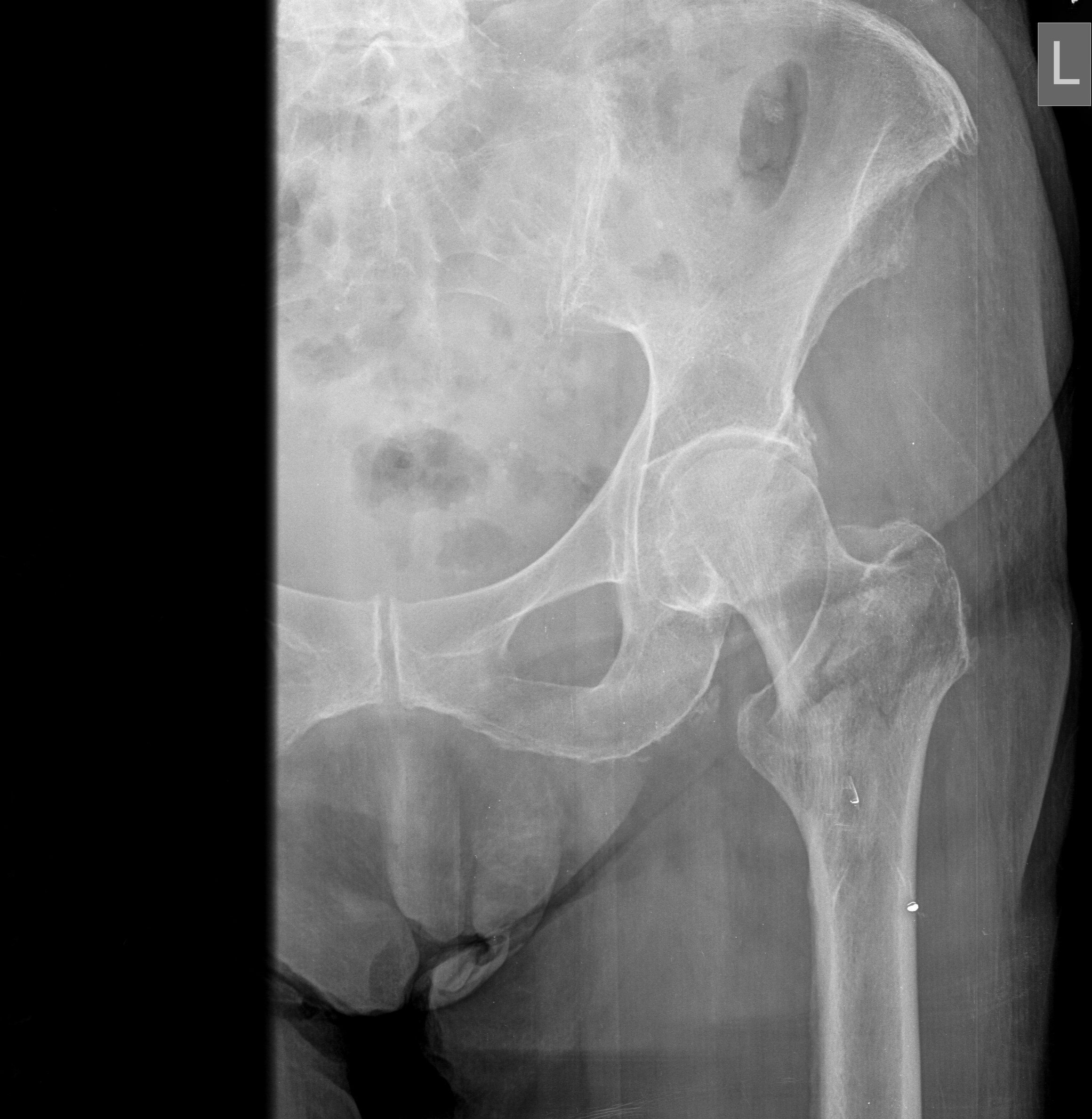 FRACTURA INFERIOR A TOCANTE MAYOR CON INVOLUCRO DE CRESTA INTERTROCANTÉRICA