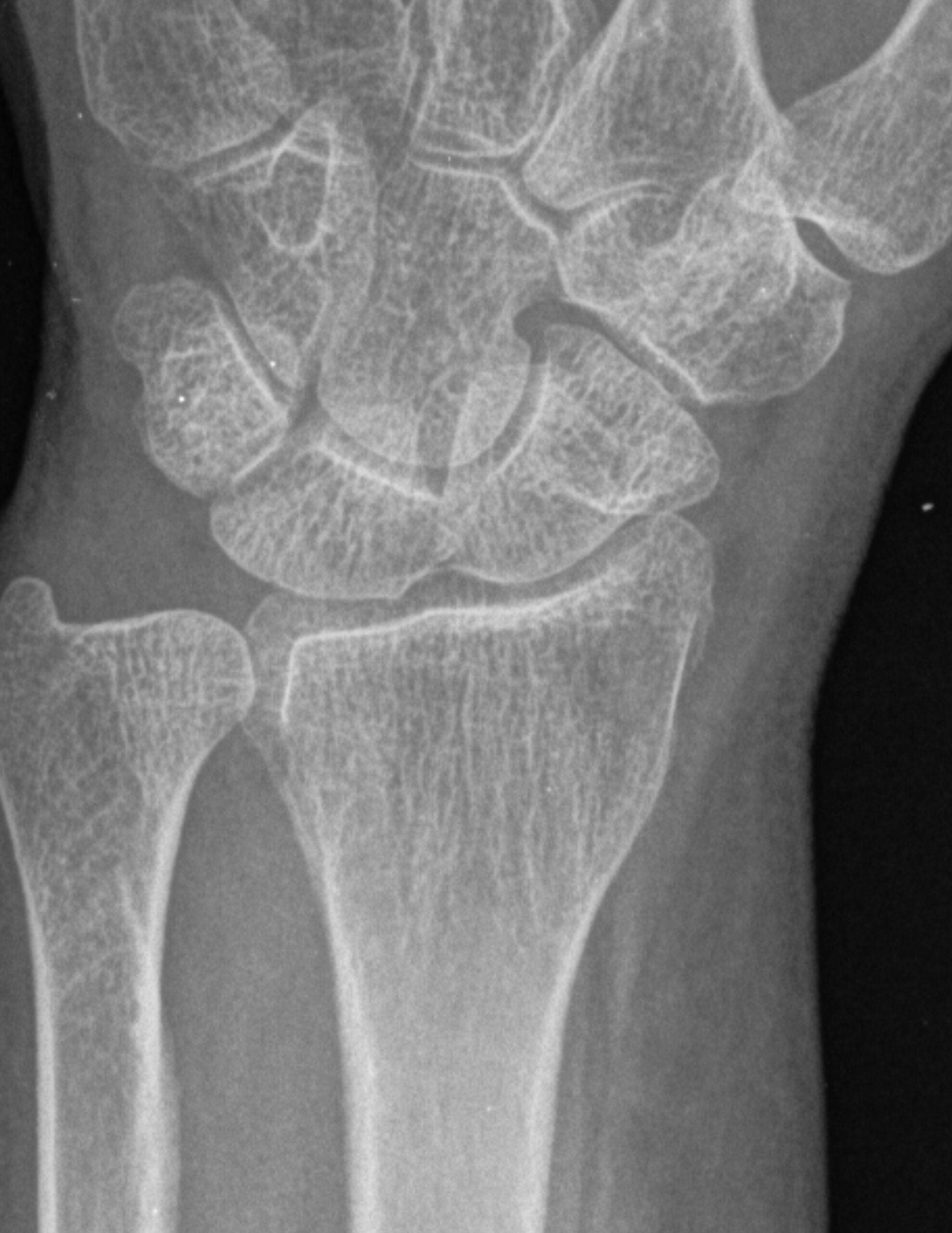 FRACTURA DE CHOFER