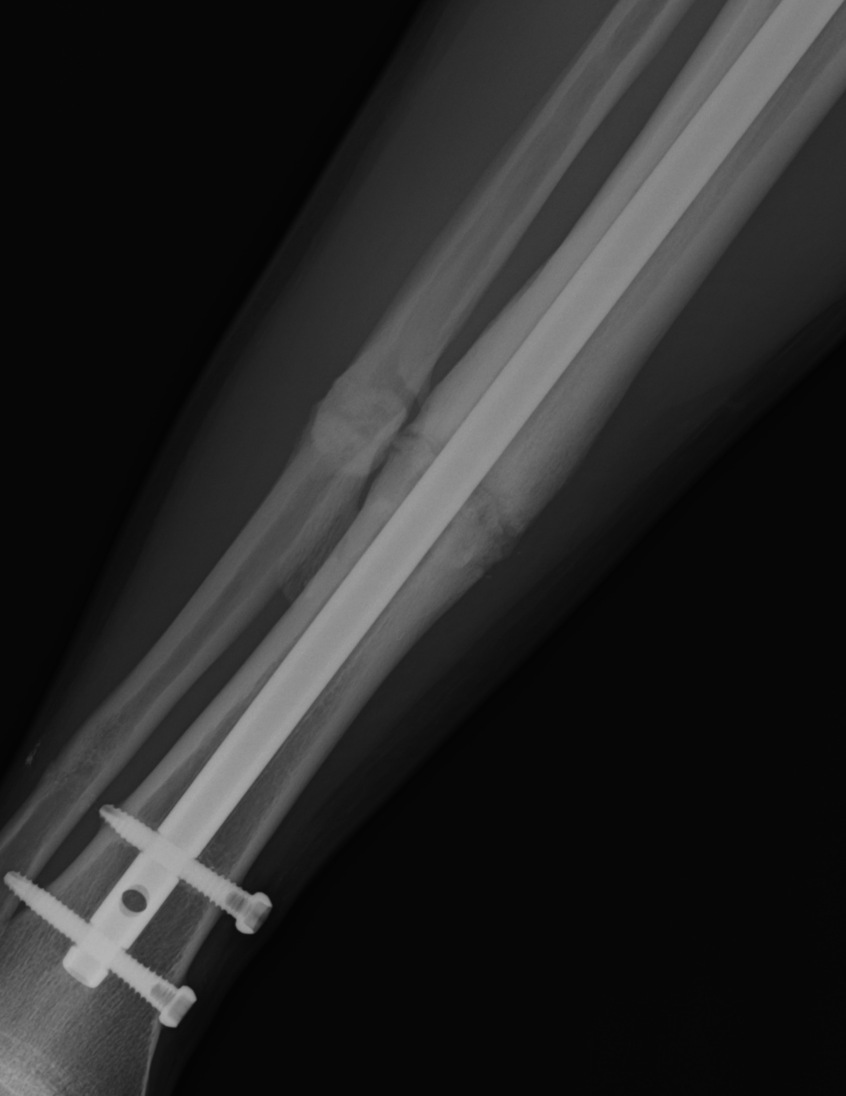 FRACTURAS OBLICUAS DE TERCIOS MEDIOS DISTALES DE DIÁFISIS PERONEA Y TIBIAL CON DATOS DE PSEUDOARTROSIS