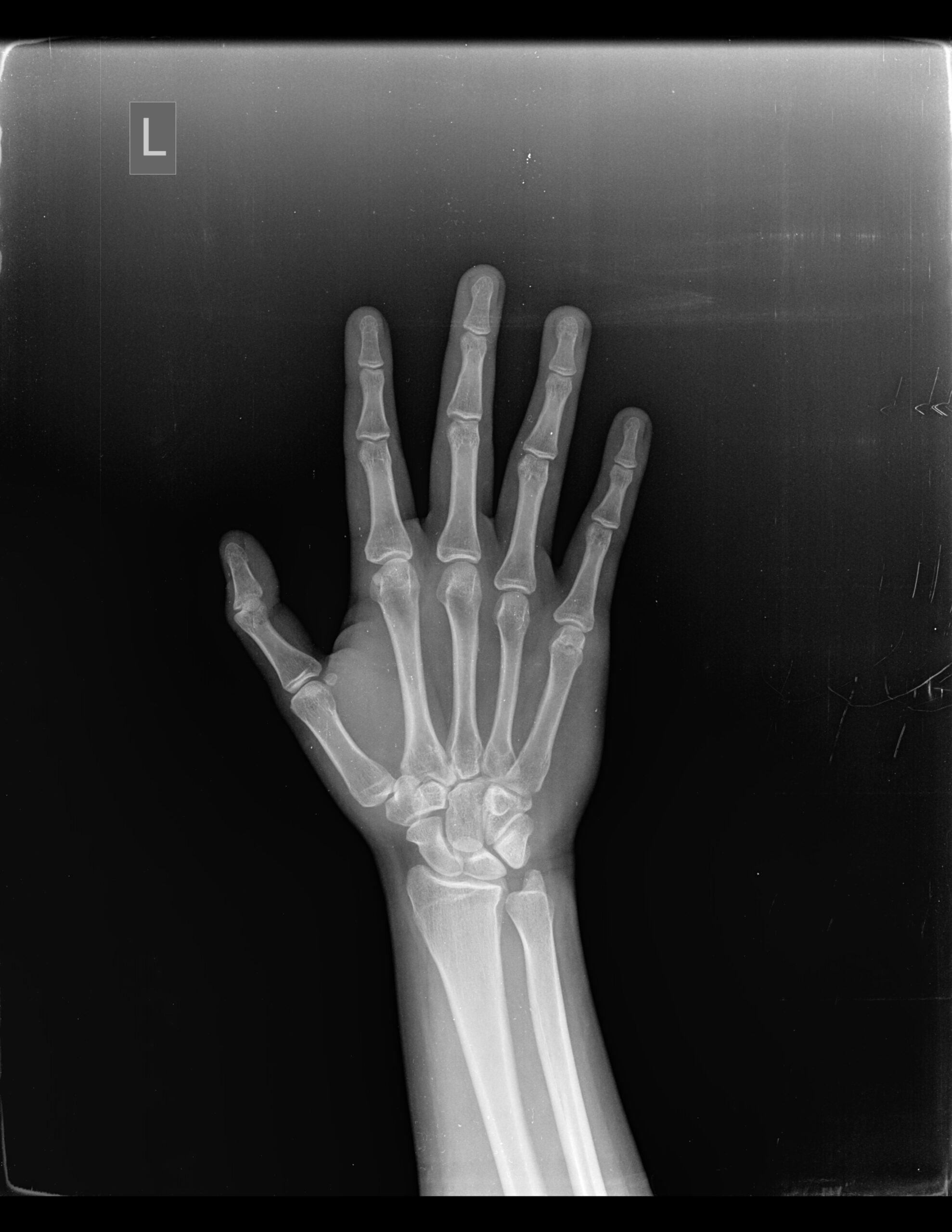 EXISTE AUMENTO DE LA LONGITUD DE APÓFISIS ESTILOIDES DEL CÚBITO QUE PODRÍA PREDISPONER A SÍNDROME DE IMPACTACIÓN DEL ESTILOIDES CUBITAL