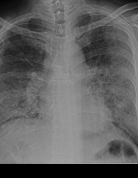 EN EL PRESENTE ESTUDIO RADIOGRÁFICO, EN EL PRESENTE ESTUDIO CON DATOS SUGERENTES DE ENFERMEDAD GRANULOMATOSA (SARCOIDOSIS) VS DE ORIGEN A DETERMINAR. 