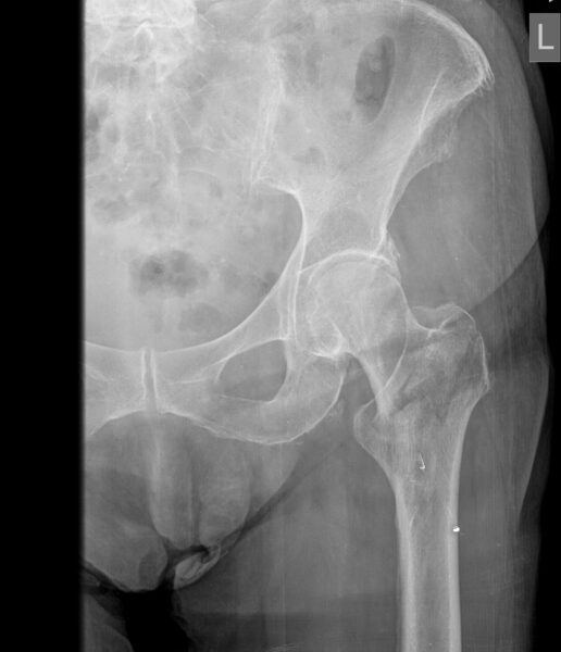 RX CADERA AP IZQUIERDA:
LO RELEVANTE ES FRACTURA DE CADERA TRANSTRONCANTERICA IZQUIERDA .
RESTO DE LOS ELEMENTOS OSEOS VISIBLES SIN APARENTE TRAZO DE FRACTURA.
MINERALIZACION OSEA DISMINUIDA.
ESPACIO ARTICULAR COXOFEMORAL DISMINUIDO.
TEJIDOS BLANDOS DE DENSIDAD CONSERVADA