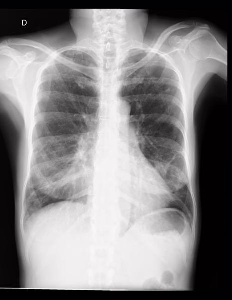 Ambos pulmones son simétricos. De manera bilateral, se identifican opacidades reticulares gruesas, mismas que muestra distribución difusa, con mayor compromiso sobre las regiones basales. No se observan nódulos ni zonas de consolidación.